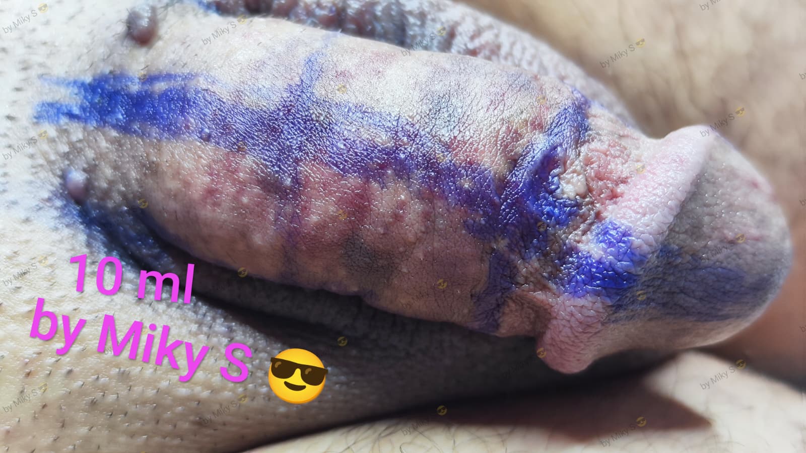 Îngroșare Genitală Masculină și Alungire Relativă cu Acid Hialuronic