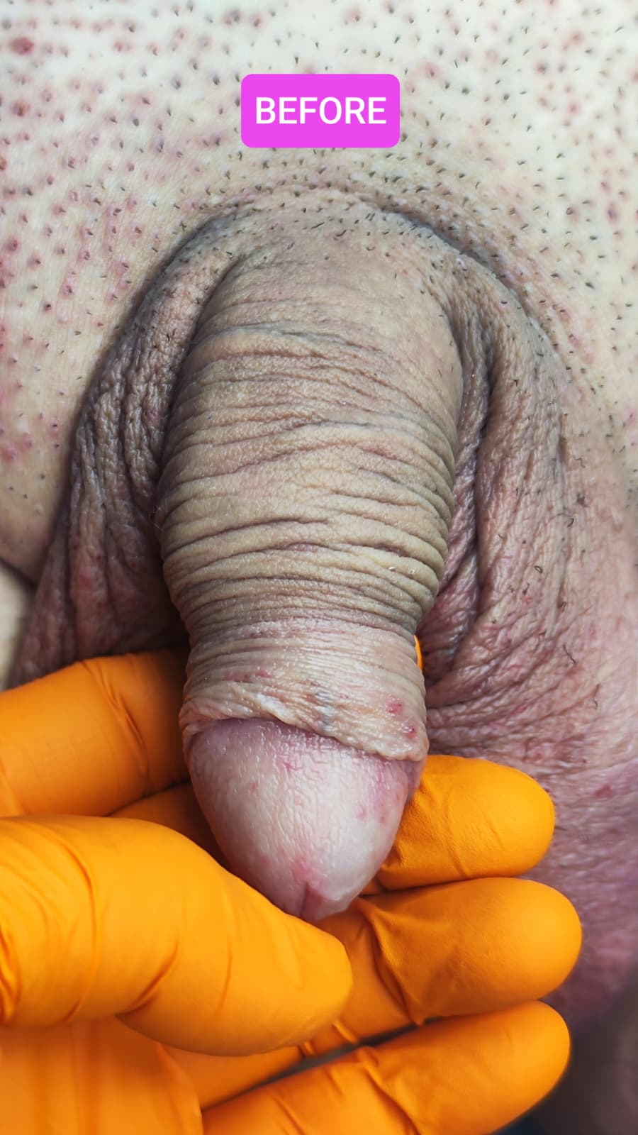 Îngroșare Genitală Masculină și Alungire Relativă cu Acid Hialuronic